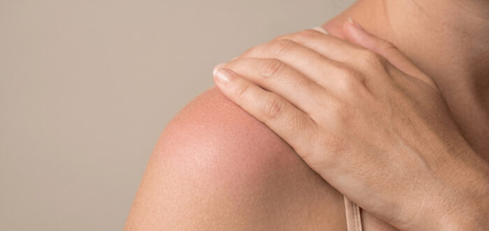 Coup de soleil : que faire pour soulager et réparer sa peau ?