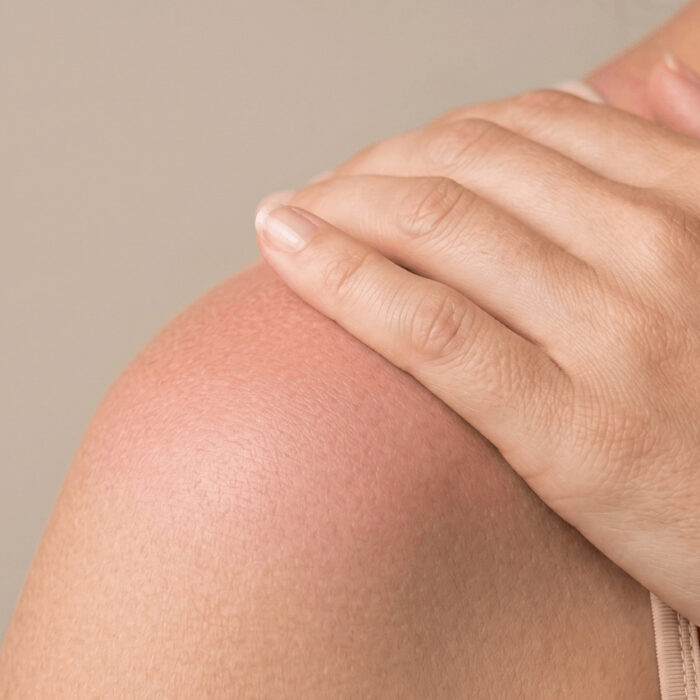 Coup de soleil : que faire pour soulager et réparer sa peau ?