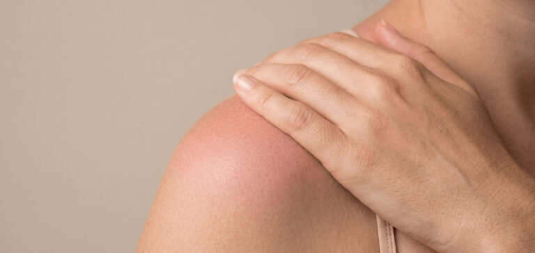 Coup de soleil : que faire pour soulager et réparer sa peau ?
