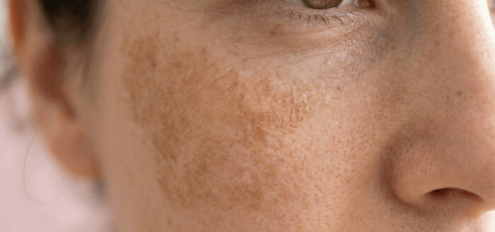 Tâches de soleil sur le visage : comment les prévenir et les atténuer ?