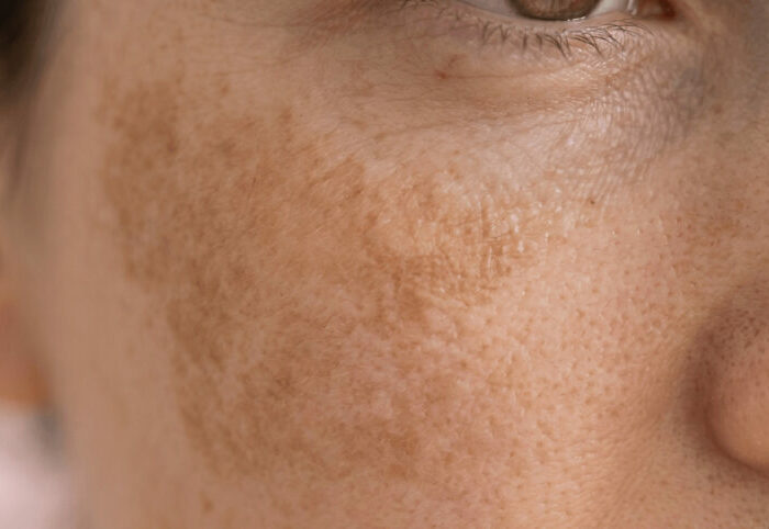 Tâches de soleil sur le visage : comment les prévenir et les atténuer ?