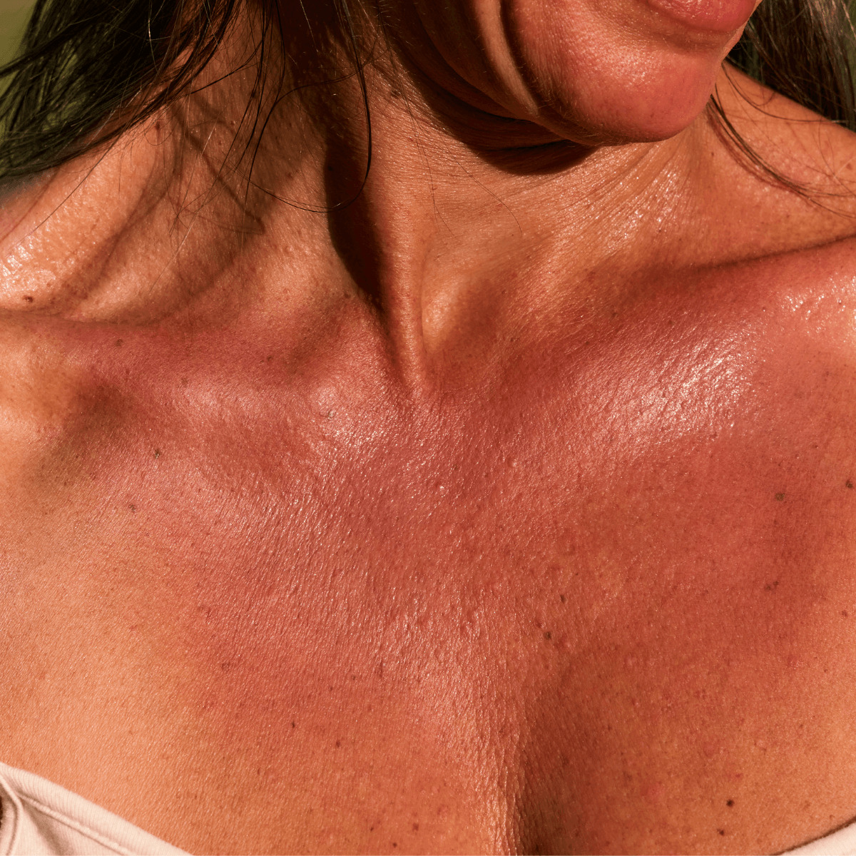 Illustration des effets du soleil sur une peau irradiée après une radiothérapie - MEME COSMETICS